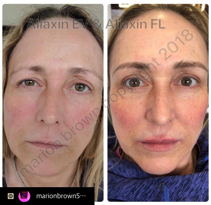 #Aliaxin #AliaxinEV #AliaxinFL #dermalfiller #dermalfillers #Hydrolift #IBSA #hyaluronicacid #hyaluronicacidexperts