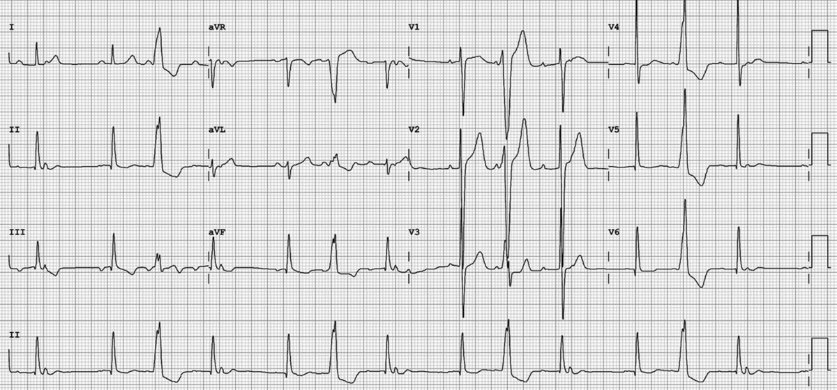 #CircECG: 18 yo man with h/o #WPW ablation p/w a regular narrow-complex tachycardia at ~200 bpm. What abnormalities are present on the post-conversion ECG? goo.gl/eQ1WBb