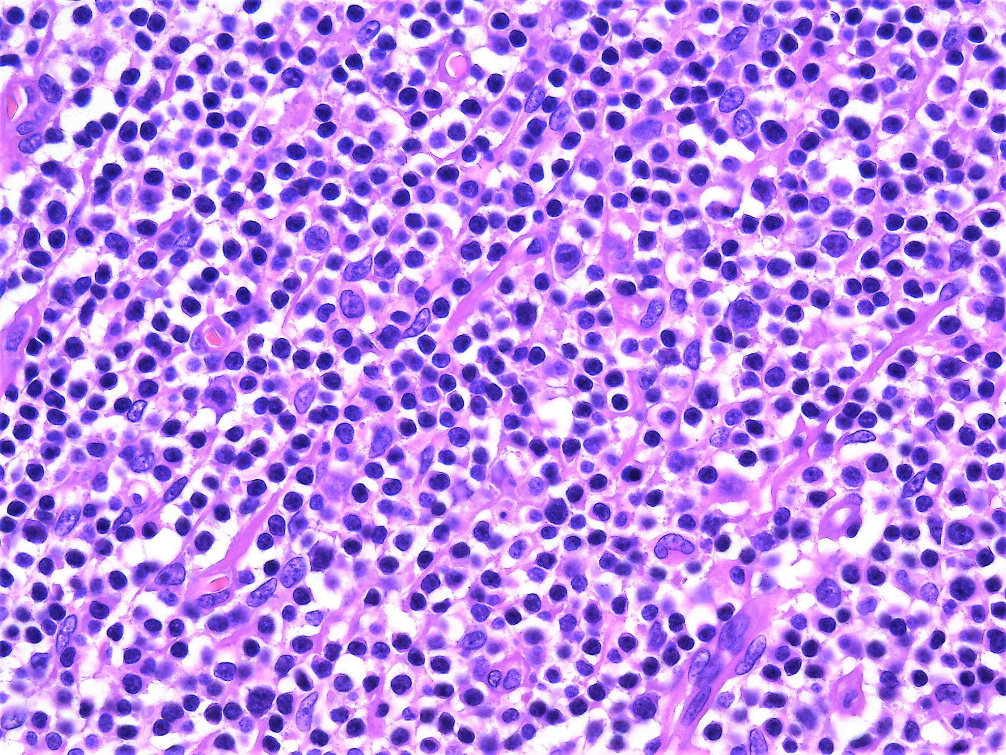 B cell follicular lymphoma