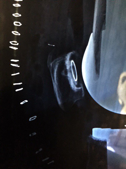ElaZemp2's tweet photo. @KneeReplacement @mykneeguide @mattbarbermd @TheKneePainGuru @neiltheknee, well I found out what the thing is on my X-ray, tip of a stitch needle... This knee is a drama which will never end... Oh and I might have a chipped patella also including bone pieces floating around... https://t.co/Rq1raXtAYc