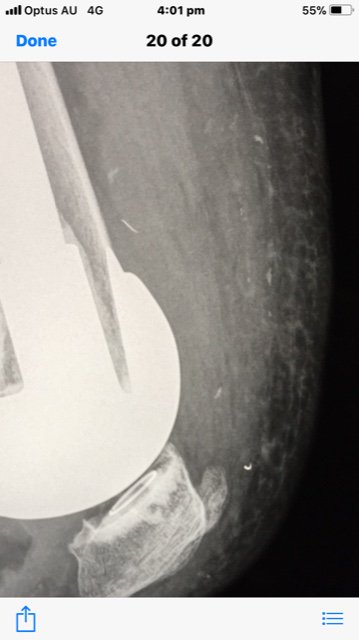 ElaZemp2's tweet photo. @KneeReplacement @mykneeguide @mattbarbermd @TheKneePainGuru @neiltheknee, well I found out what the thing is on my X-ray, tip of a stitch needle... This knee is a drama which will never end... Oh and I might have a chipped patella also including bone pieces floating around... https://t.co/Rq1raXtAYc