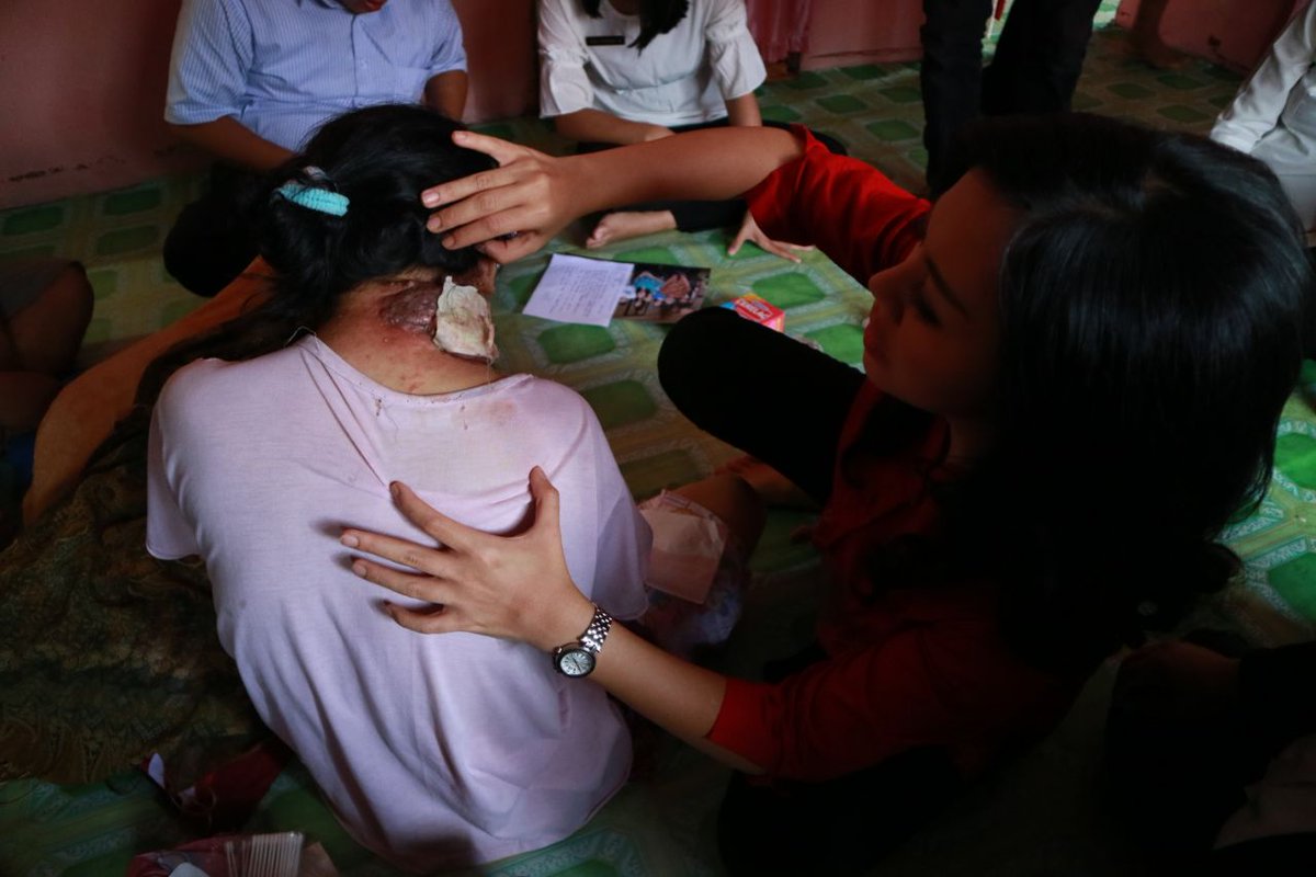 dr_karolin's tweet photo. Bu Regina terkena kanker mulut, pada awalnya seperti sariawan di lidah, lambat laun semakin parah hingga menggerogoti lehernya. Setelah melihat kondisinya saya langsung berkoordinasi dengan Plt. Bupati Landak Bapak Herculanus Heriadi untuk membantu pengobatan Regina. https://t.co/UzPxUkDphD