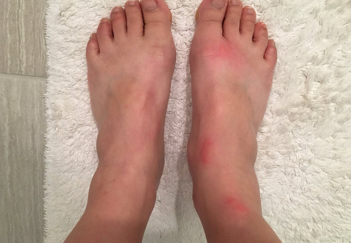 JodyBugsMeUNL's tweet photo. What’s even grosser than my feet? My feet with bug bites. So gross! Itchy & gross. Finally talked to hotel manager after midnight & instead of being mad, I started teaching him about #bedbug biology #bedbugdogs https://t.co/ThX8hFZlIA