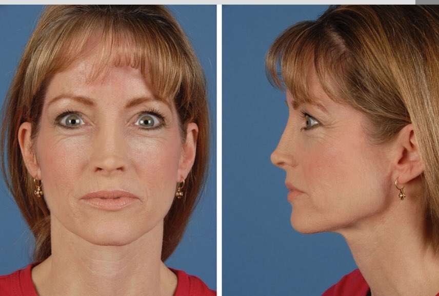 Heather Furnas, MD (@drheatherfurnas) on Twitter photo Digital imaging in secondary #rhinoplasty <a href="/prsjournal/">Plastic and Reconstructive Surgery</a> <a href="/DrLeePlastic/">Michael Lee, M.D.</a> @SRamanadhamMD <a href="/DrRodRohrich/">Rod Rohrich, M.D.</a> journals.lww.com/plasreconsurg/… #plasticsurgery Digital imaging in secondary #rhinoplasty <a href="/prsjournal/">Plastic and Reconstructive Surgery</a> <a href="/DrLeePlastic/">Michael Lee, M.D.</a> @SRamanadhamMD <a href="/DrRodRohrich/">Rod Rohrich, M.D.</a> journals.lww.com/plasreconsurg/… #plasticsurgery