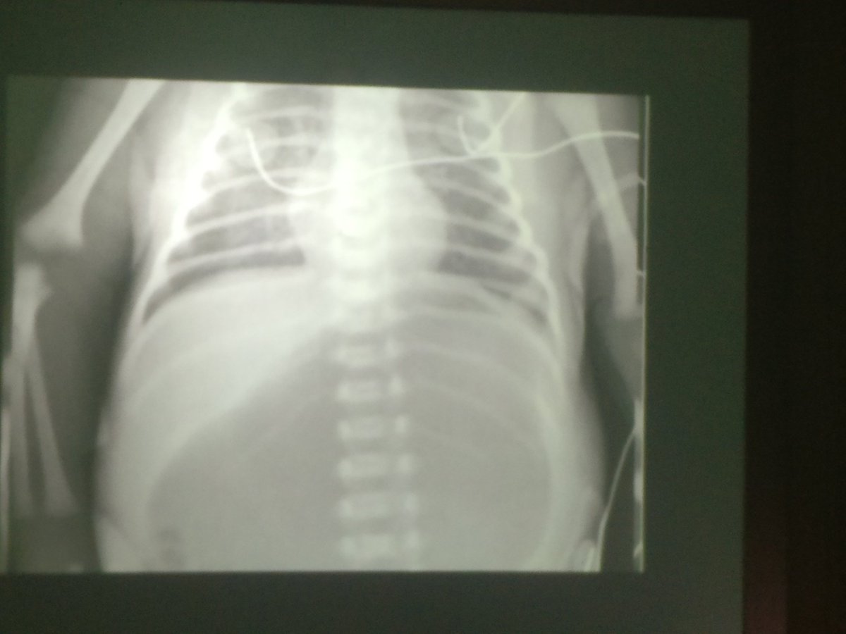 sailordoctor's tweet image. On a rhodopsin rollercoaster in the lecture theatre today on the #CATcourse today so that we can see the image slides clearly. The learning point is clear though- a stomach full of air can be an abdominal cause of a breathing problem.