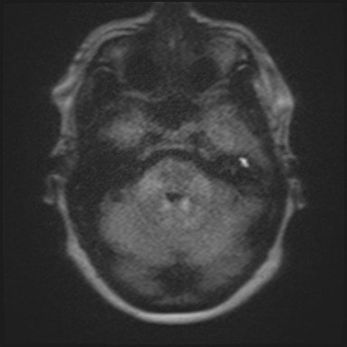 JennyKHoang's tweet image. Awesome T-bone Case I didn't show at #DukeReview: 

Restricted diffusion in cholesteatoma on MRI. 
Need dedicated protocol with coronal views. Thx to @gmoonis for sharing her experience. #radres @DukeRadiology 

MORE: pubs.rsna.org/doi/full/10.11…