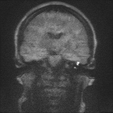 JennyKHoang's tweet image. Awesome T-bone Case I didn't show at #DukeReview: 

Restricted diffusion in cholesteatoma on MRI. 
Need dedicated protocol with coronal views. Thx to @gmoonis for sharing her experience. #radres @DukeRadiology 

MORE: pubs.rsna.org/doi/full/10.11…