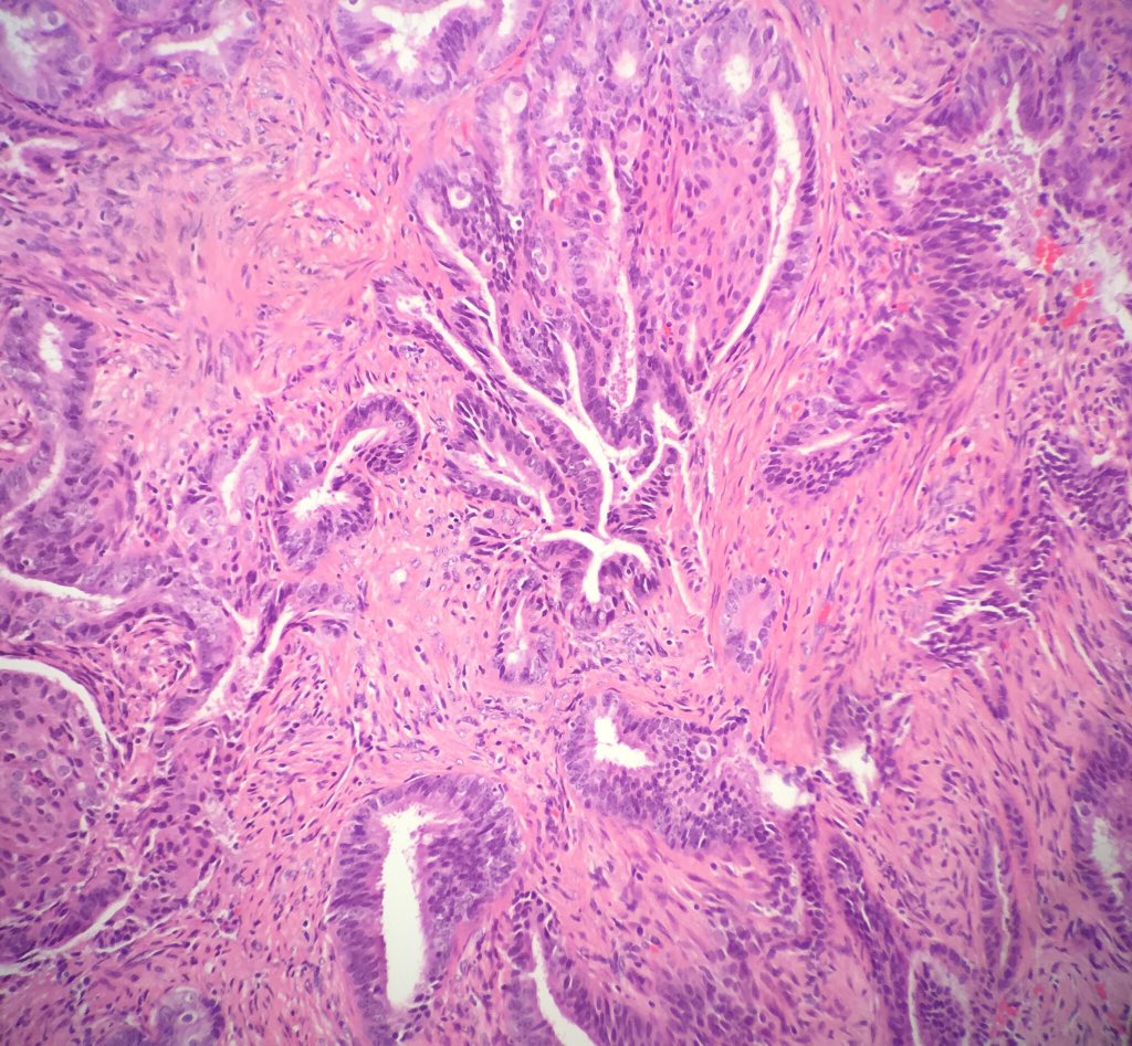 Anne Mills (@annemillsmd) on Twitter photo Atypical Polypoid Adenomyoma in the LUS of a 40-yo. Described by Teri Longacre of <a href="/StanfordPath/">Stanford Pathology</a> in 1996, APAs are characterized by complex endometrioid glands arranged in fibromuscular stroma. Squamous met is prominent! ncbi.nlm.nih.gov/m/pubmed/85406… Atypical Polypoid Adenomyoma in the LUS of a 40-yo. Described by Teri Longacre of <a href="/StanfordPath/">Stanford Pathology</a> in 1996, APAs are characterized by complex endometrioid glands arranged in fibromuscular stroma. Squamous met is prominent! ncbi.nlm.nih.gov/m/pubmed/85406…