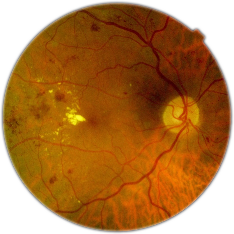 📢 Seminario online GRATUITO #OPTretina: Actualizaciones en Retinopatía Diabética (II) > Miércoles 07/03/2018 de 15:00h a 16:00h (GMT+1) > Impartido por <a href="/GallegoPinazoMD/">Dr Gallego-Pinazo</a> ¡Ya puedes inscribirte! ➡️ bit.ly/WebinarsOPTret…