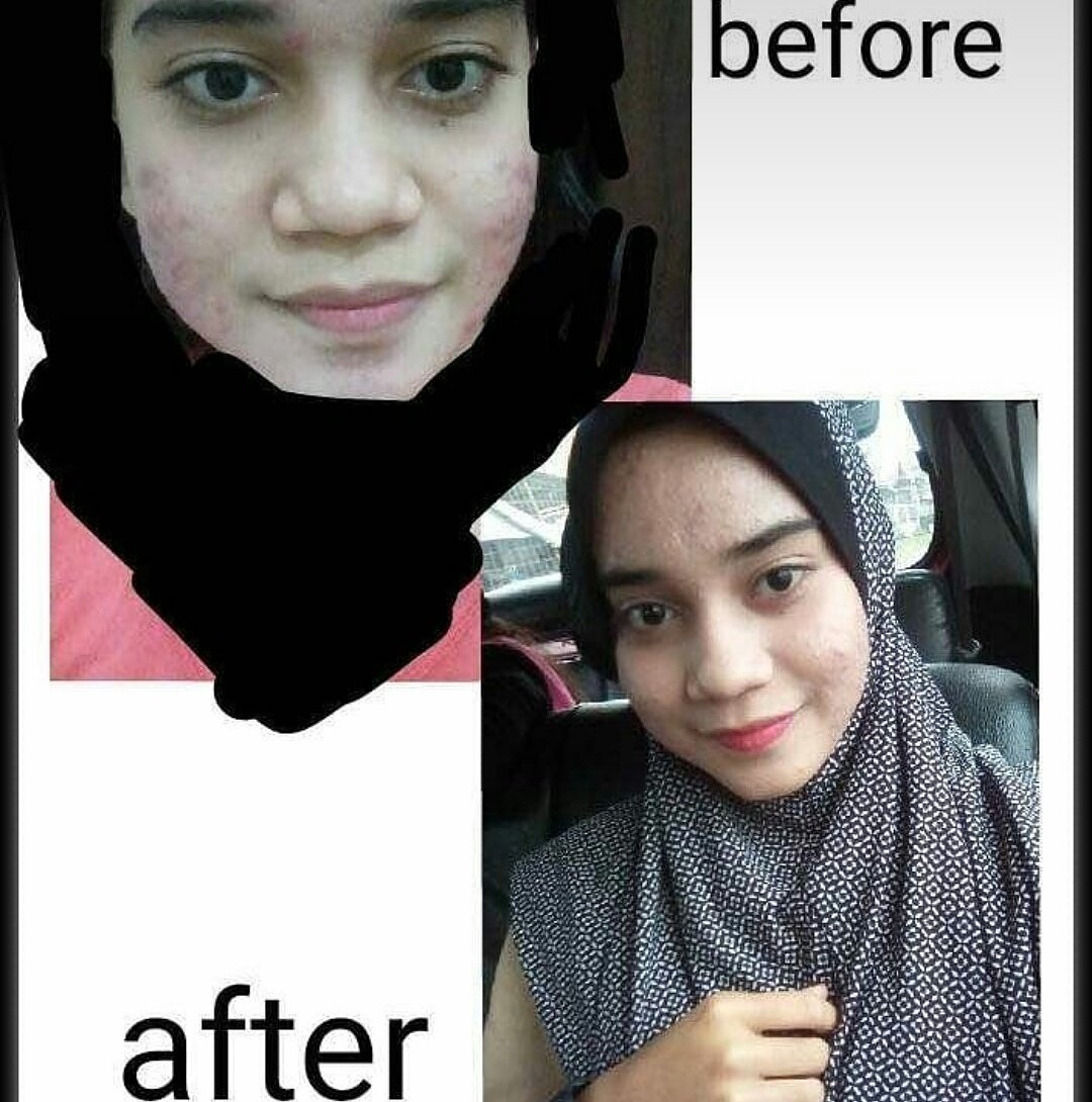 profixforever's tweet photo. #profix ni sis mmg rekemen sgt dekat korang yg ada masalah kulit muka.  Nak lagi kesan kebaboom pakai dgn #qalishcleansinggel

Seunit rm49 FREE POS

Wasap sis cepat 👇👇
https://t.co/VXYQMwFSTh https://t.co/h9nsuH70DB