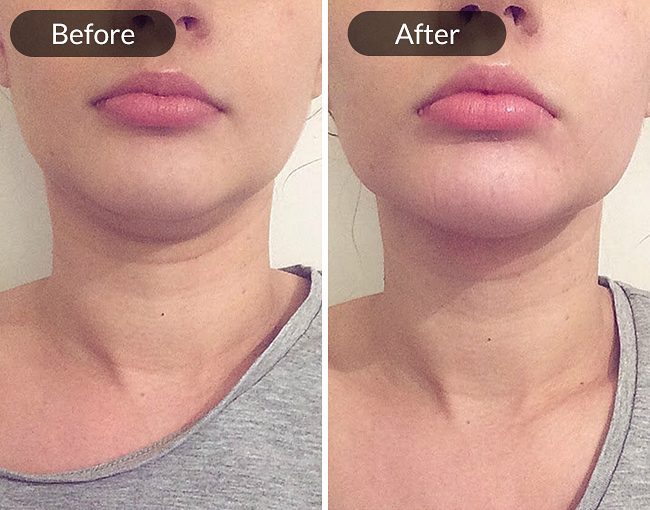 upyoursgravity's tweet photo. Check out this Before and After comparison from using our Chin Up Mask!
Get your FREE sample HERE: https://t.co/mUjNkSh66Y
#loseweight #contour #beauty #beautyblogger #facemask #skincare #chinreduction https://t.co/7rkGZCNUsJ