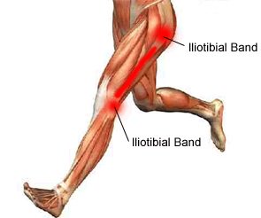 ContactOptimal's tweet photo. ITB syndrome is seen a lot in our running clients getting a vague dull ache around the outside of the knee and it can be down to technique or lack of strength around the hip. We will diagnoses the symptoms, manage the pain, and treat the problem! https://t.co/ECoSNiYPu5