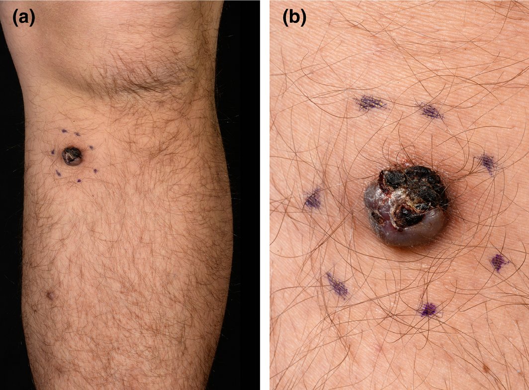 An enlarging nodule on the shin; mimics of melanoma 
 onlinelibrary.wiley.com/doi/10.1111/ce…