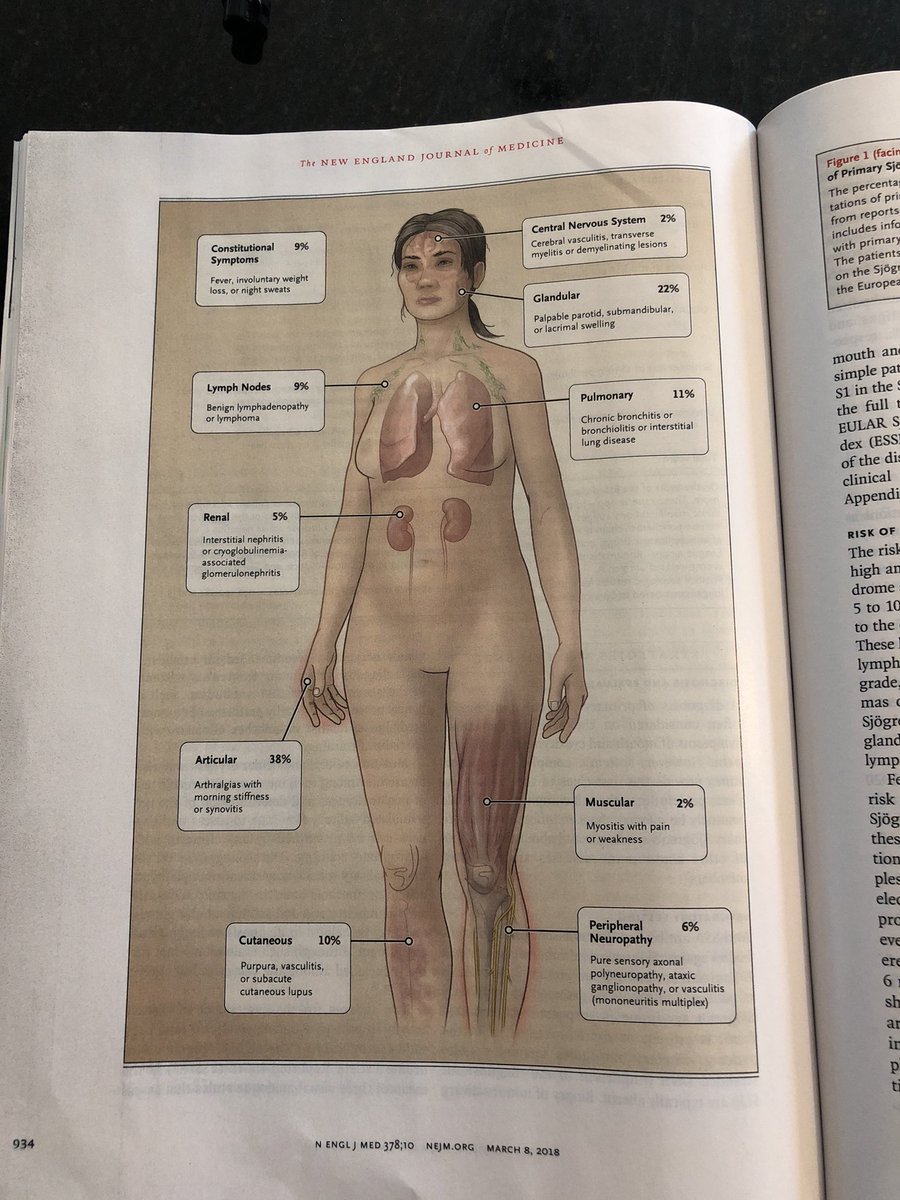 Nice article on Sjogren's in this week's <a href="/NEJM/">NEJM</a>