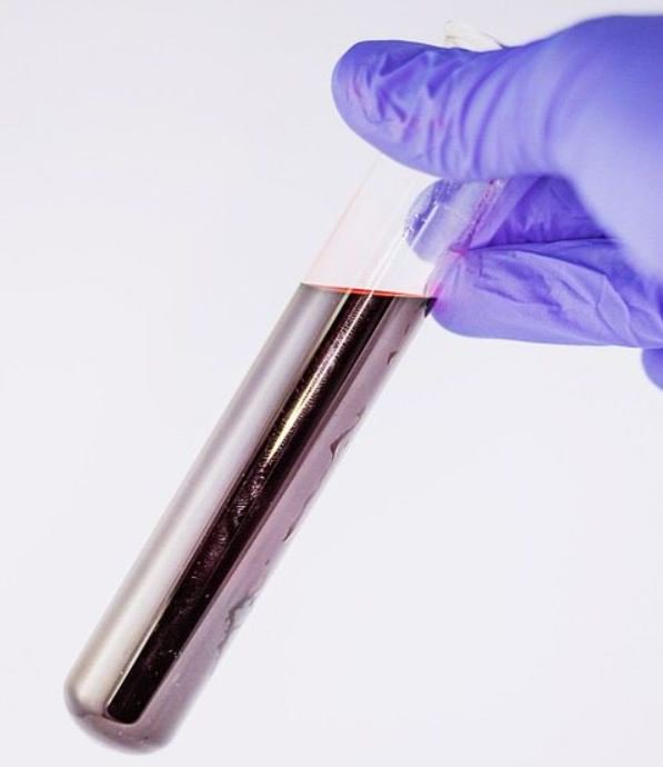 The DYANMIC-III trial examines whether decisions about chemotherapy for #colorectalcancer patients can be made using blood tests to detect the presence of tumours: ow.ly/5q6g30iGhWN #ColorectalCancerAwarenessMonth