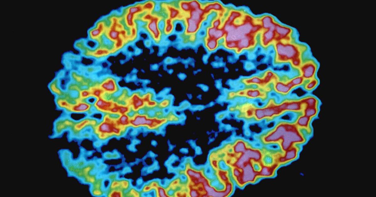 monarchaz's tweet photo. #AntiInflammatory #BrainTrauma Study Finds Brain Damage From Cannabis Is Less Severe Than Alcohol Consumption https://t.co/7iF468rVMd #monarchaz https://t.co/pKEs5MFKrf