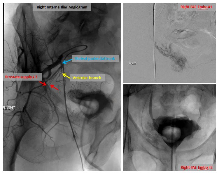 72 yo w/acute urinary retention 2/2 BPH. Remote h/o TURP. VIR consulted for PAE. Great clinical result. For more case info check out AlbanyIR.com/pae-case-1 and AlbanyIR.com/prostate-arter… for more about PAE. #IRad #PAE <a href="/SIRRFS/">SIR RFS</a> <a href="/JVIRmedia/">JVIR</a>