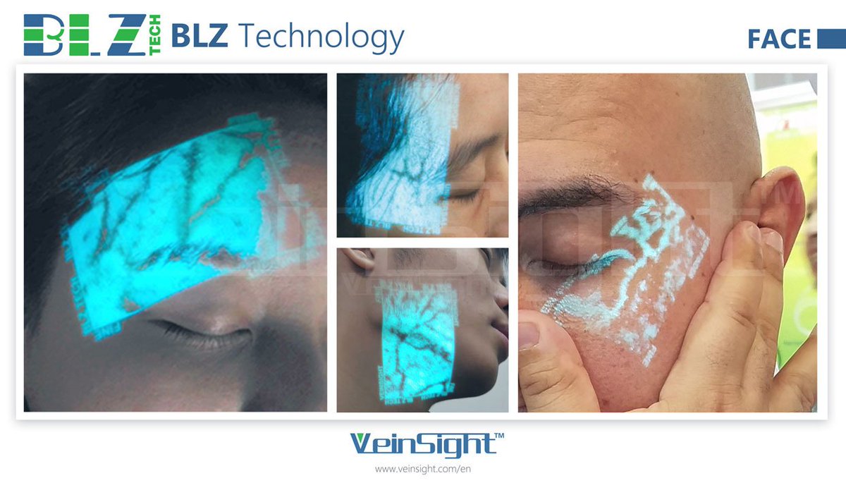 VeinSight™ Vein finder can locate and avoid veins during cosmetic procedures which can minimize bruising. veinsight.com
#veinfinder #medicaldevice #Medical #medicalequipment #medtech #technology #medtech2017 #medicalstudent #medicalguide #Medicaid