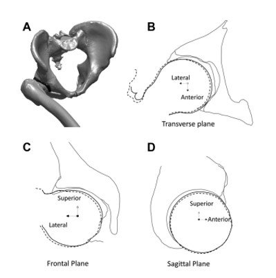 JoshuaHarrisMD's tweet photo. #Hip #Instability #Microinstability exists! The capsule matters. #IliofemoralLigament Check out our @AJSM_SportsMed study. https://t.co/veHUbsT2uU https://t.co/wzSsMourYS
