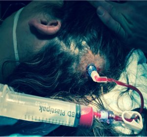 catcourse's tweet image. Looking forward to a good Q&amp;amp;A session with our resident expert paediatric neurosurgeon this morning.  We might ask him about this novel use of IO needles:
resus.com.au/2017/11/09/int…