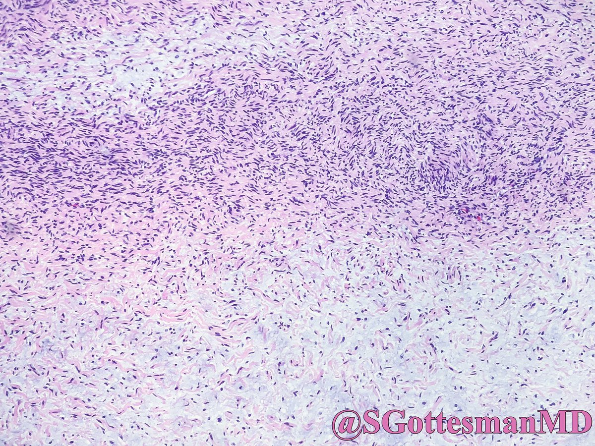 SGottesmanMD's tweet photo. Scalp of an elderly person. Myxoid neurofibroma. S100+ (cytoplasmic &amp; nuclear staining), CD34+ (membranous staining), NF (entrapped axons within lesion), Melan-A was negative. #dermpath #SilviPearls #dermatology #pathology #IHCpath https://t.co/eaDolCUdDz