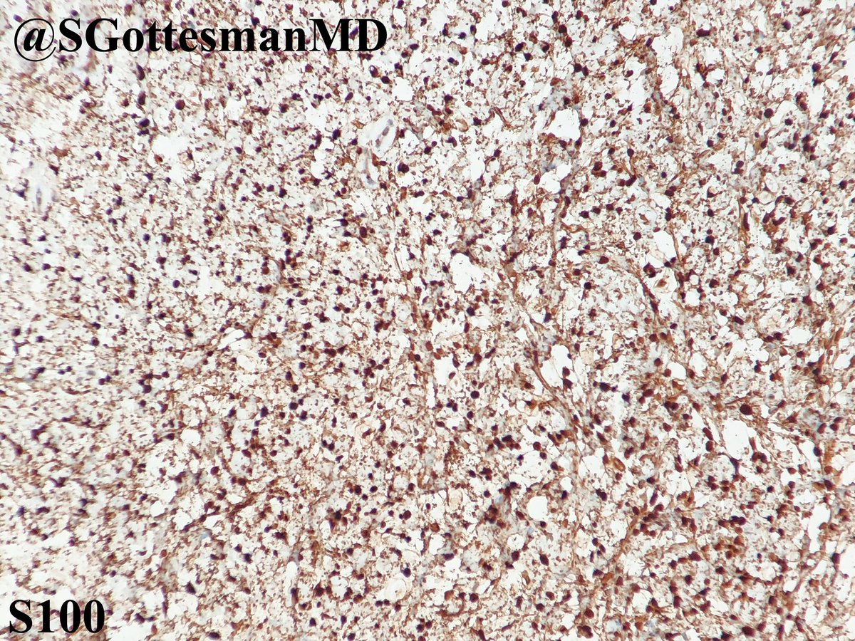 SGottesmanMD's tweet photo. Scalp of an elderly person. Myxoid neurofibroma. S100+ (cytoplasmic &amp; nuclear staining), CD34+ (membranous staining), NF (entrapped axons within lesion), Melan-A was negative. #dermpath #SilviPearls #dermatology #pathology #IHCpath https://t.co/eaDolCUdDz