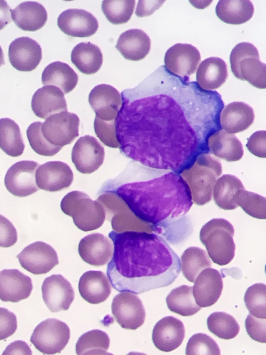gibbspath's tweet photo. Teen who ruptured spleen after untimely exit from moving car. Classic smear, nicely + Monospot. Had seen GP for pharyngitis 1 month earlier; Monospot was negative then. Moral: up to 25% of early acute EBV with classic sx will have (-) rapid test. #HemePath #Pathology #Hematology https://t.co/chtno6oqi7