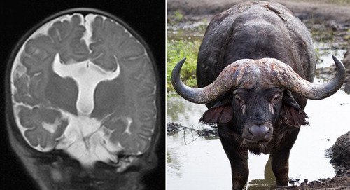 Drs. Eric Jackson and Alan Cohen report on the appearance of "buffalo horn ventricles" in <a href="/TheJNS/">Journal of Neurosurgery</a>: thejns.org/doi/10.3171/20…