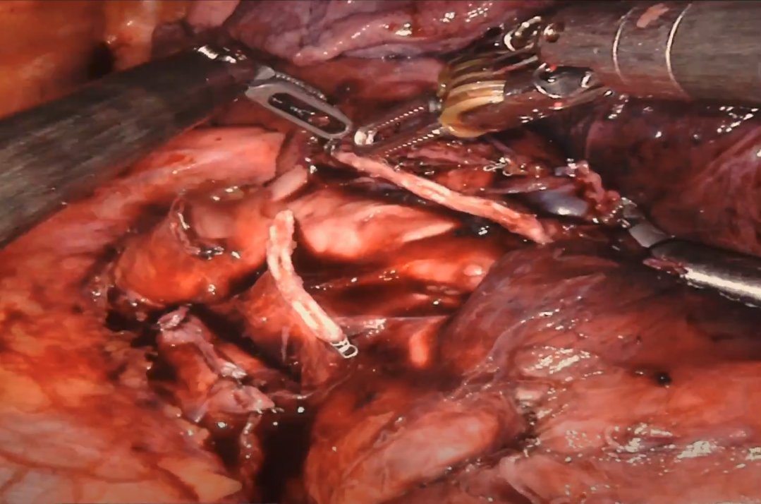 ctsnetorg's tweet photo. New on CTSNet: Robotic Left Upper Lobectomy #tssmn #Surgery #Thoracic #Lung #Cancer #MedEd #Resident https://t.co/0B2OatLQmb https://t.co/xPVVovTJeJ
