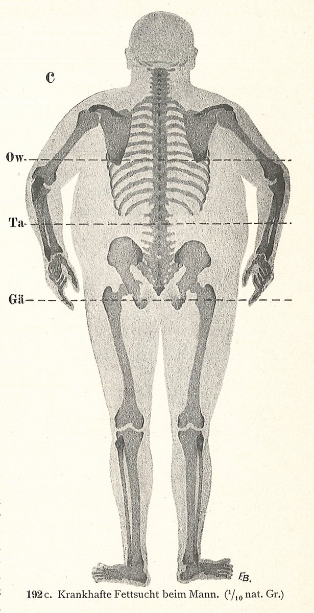 伊豆の美術解剖学者 太った人の骨格図 単なる肥満であれば 骨格は普通の人とほぼ同じ 脂肪の蓄積が起こらない箇所 上前腸骨棘や鼡径靭帯など は 常に触れるらしい
