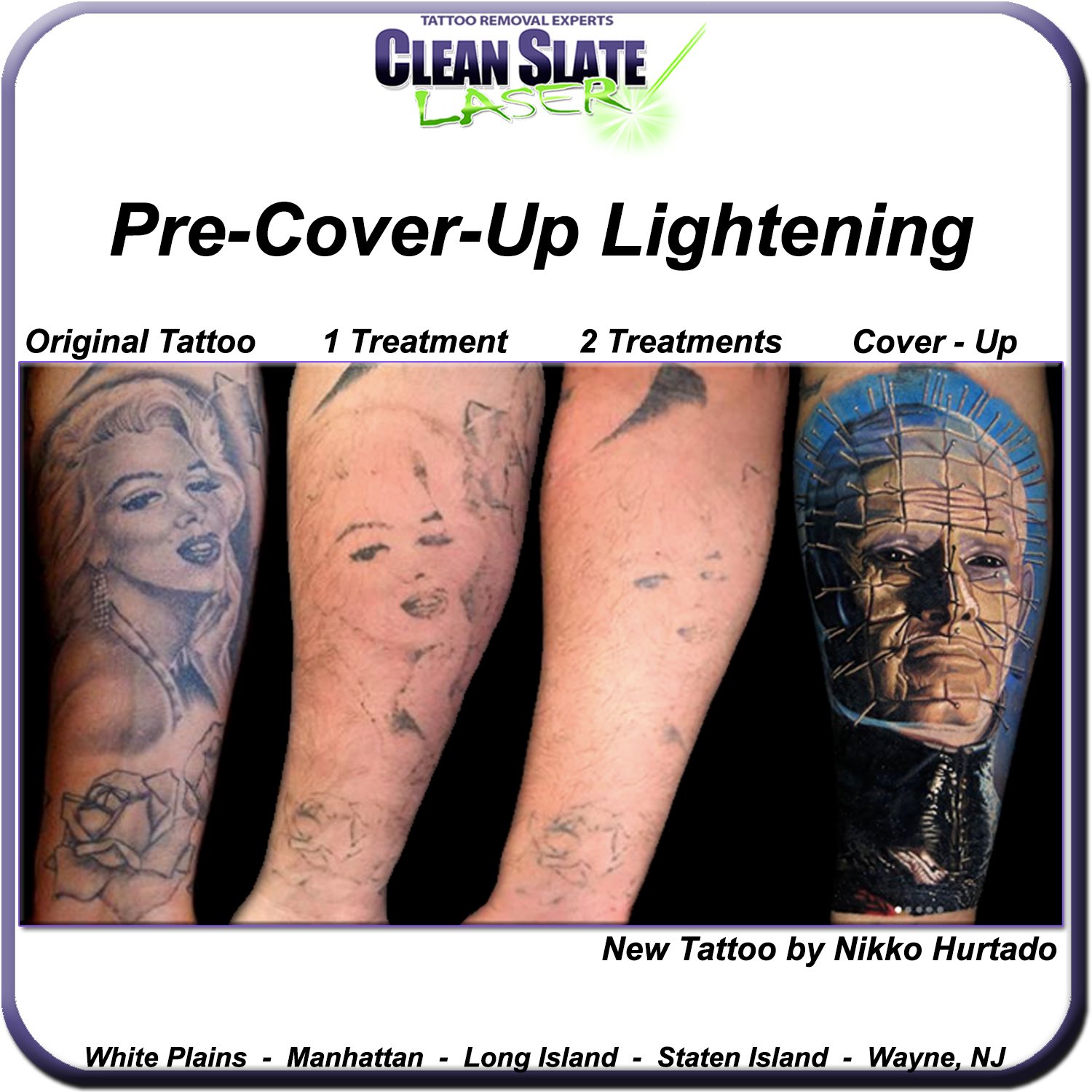 Tattoo Removal Long Island Manhattan NY