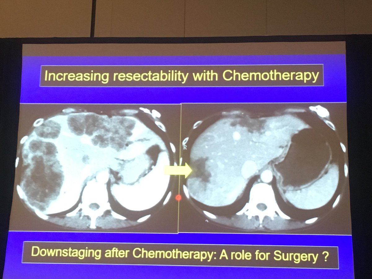 hernandezliver's tweet photo. Dr René Adam presenting When to operate Liver Mets... answered: as much as possible @ahpba #ahpba18 https://t.co/RICBcMF7EZ