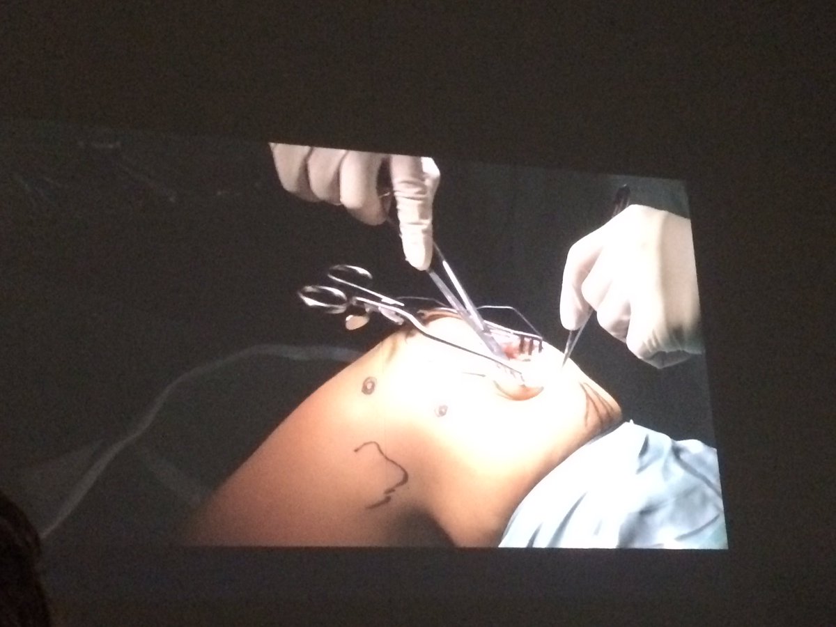 Wat een goed congres gisteren! Goede sprekers en live surgery <a href="/stantoniusz/">StAntoniusZiekenhuis</a> <a href="/MA_newsfeeds/">Movement Academy</a> #leerzaam