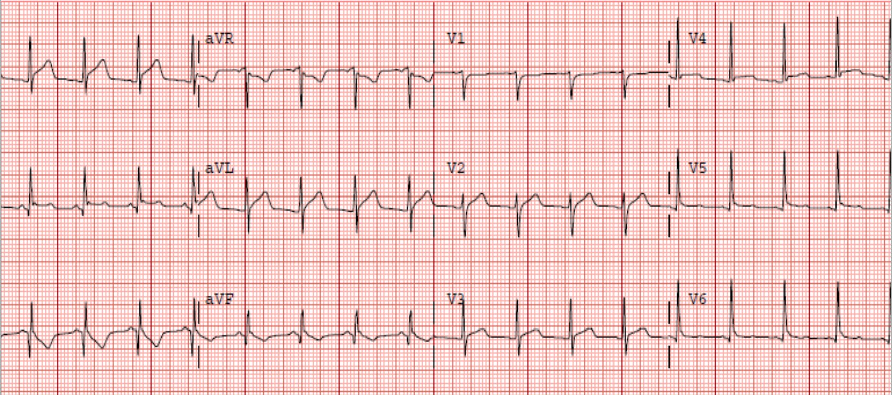 Pericarditis Diffuse St Elevation