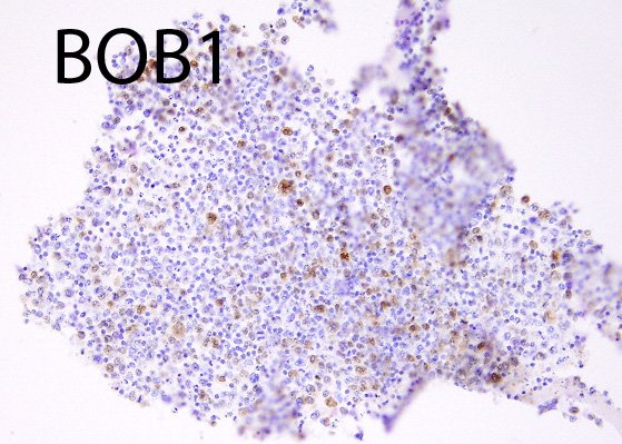 ARP_Press's tweet photo. Primary effusion lymphoma HHV8+/EBV+, from Dr. Dennis O'Malley of our advisory board for the 5th series of AFIP Fascicles.  Of all the pan B cell markers, BOB1 is mostly commonly expressed in PEL, even when all other B cell markers are lost. Buy his book! https://t.co/Uu8QV9Petx https://t.co/9otECQOpHZ