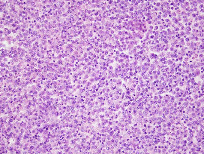 ARP_Press's tweet photo. Primary effusion lymphoma HHV8+/EBV+, from Dr. Dennis O'Malley of our advisory board for the 5th series of AFIP Fascicles.  Of all the pan B cell markers, BOB1 is mostly commonly expressed in PEL, even when all other B cell markers are lost. Buy his book! https://t.co/Uu8QV9Petx https://t.co/9otECQOpHZ