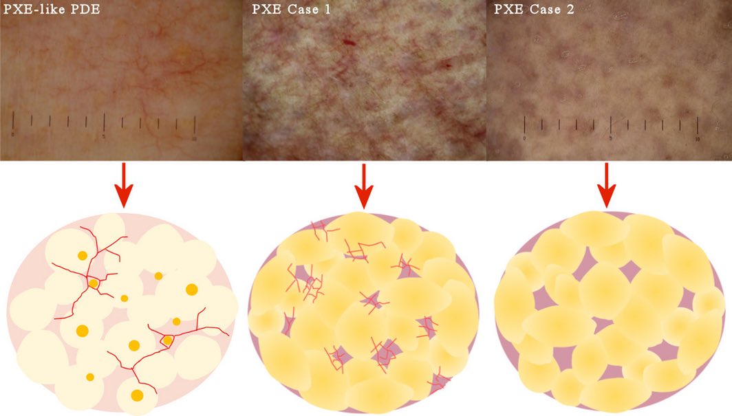 Are you aware of the dermoscopic features of Pseudoxanthoma elasticum?
#dermatology #dermoscopy #MedEd
onlinelibrary.wiley.com/doi/10.1111/ce…