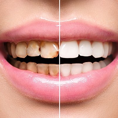Do you have a cavity and think a filling may cramp your smile style? Here's the good news- it won't! Discover more here: goo.gl/nexAUH