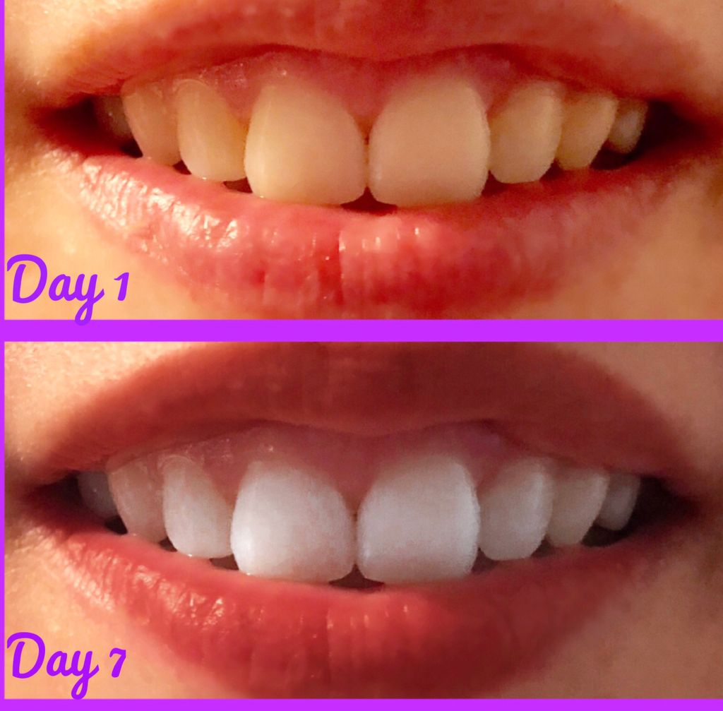 RoxxSmilez's tweet photo. 😱 My Own Results! BURST #whitestrips sent that #CoffeeStain Packing!! ☕️😁💫 10 minutes a day with #NOSENSITIVITY!! Save $5 Using my Professional #Discount and pay only $14.99!(🤫shh, use my discount for the #electrictoothbrush too)!*link in bio* #teeth #ambassador #roxxsmilez https://t.co/2FMDJt1s4P