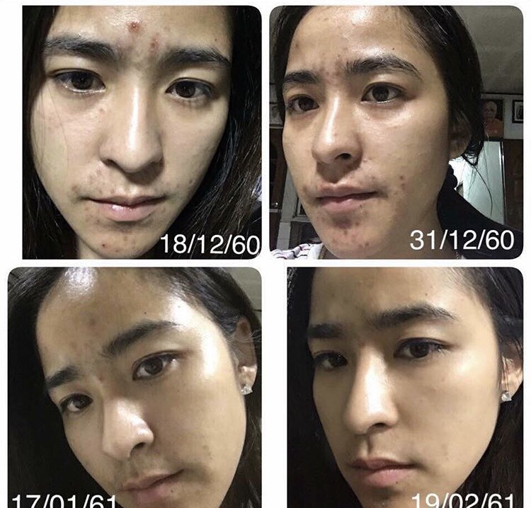 Primayaaaa's tweet image. ครีมอะไรก็ช่วยหน้าหายพังไม่ได้. แต่วีนส์ช่วยได้ 😉 
🔰หน้าหายพังแล้วยังจะปังอีกค่า🔰

📲 👉🏻  bit.ly/2sEcvJd 
#Primaya #ลดน้ำหนัก #หุ่นสวย #howtoperfect #howtobeauty #ฉันจะผอม #ถูกและดีบอกต่อ #ของดีบอกต่อ