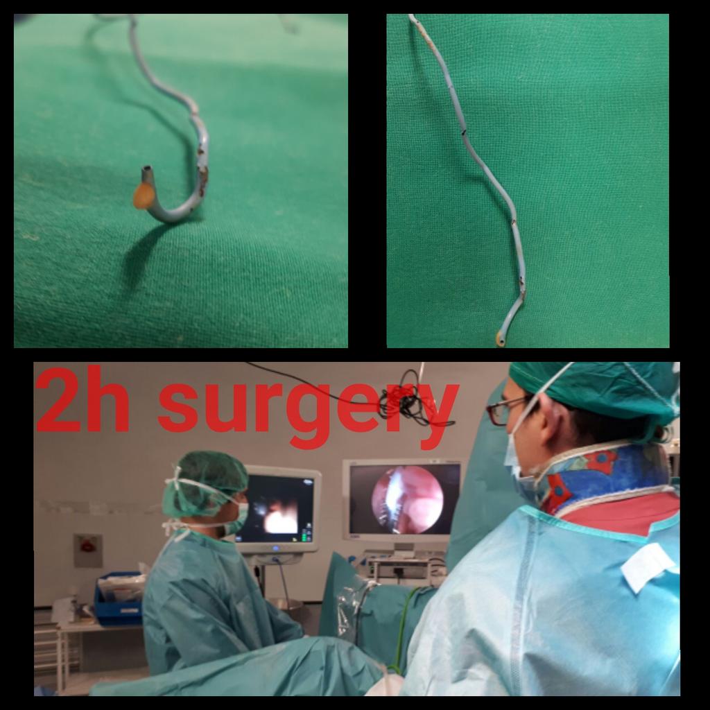 DrMainez's tweet photo. Looking forward to know the results of @Devicare study of the l-methionine in encrusted catheters after two hours in OR to remove an encrusted double j catheter by miniECIRS @LitControl https://t.co/QSlhz6s76T