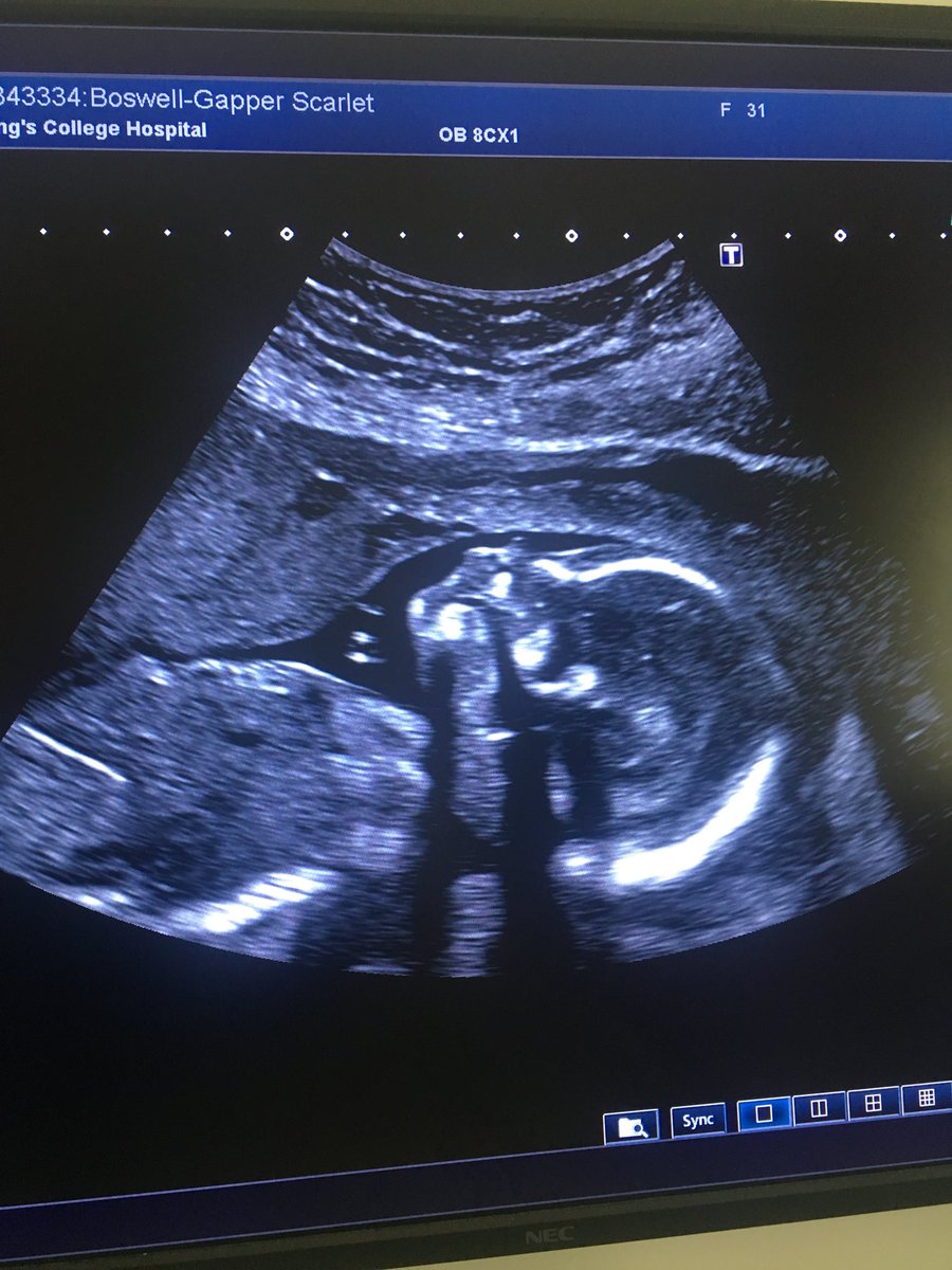 scarletgapper's tweet photo. Bean growing nicely #21weekscan https://t.co/wXfsxVSO4O