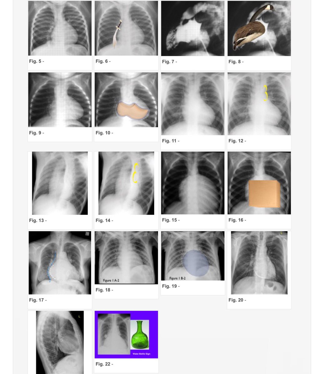 Andres Obeso A Twitter Proud To See How My Radiological Sign Earth Heart Sign Published In Lancet Has Been Chosen By This Article As One Of The Most Famous Cardiac Signs Along With