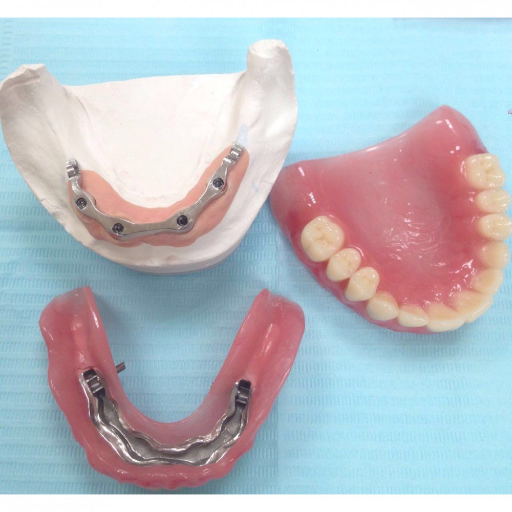 Нижний протез зубов какой. Протез на 4 имплантах верхней челюсти титановая балка. Балочный протез на 4 имплантах. На 4 имплантах бюгельный протез. Полный покрывной протез на балке на 4-х имплантах.