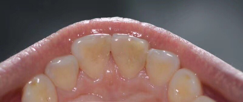 TOP_dentallab's tweet photo. How do you like this work by us? #veneers #dental #dentistry #dentallab #dentaltechnician #topdental #topdentallab #outsourcing #madeinchina #porcelainveneers #allceramic #smile https://t.co/kCyfhrMywK