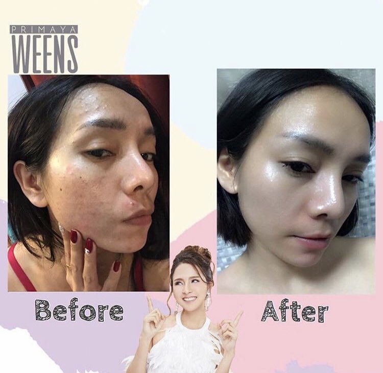 Primayaaaa's tweet image. จากหน้าเคย”พัง” แต่เด่ยวนี้อะ “ปัง” แล้วนาจา 😉

ชงวีนส์วันละ 1-2ซอง ทานตอนท้องว่างเช้าหรือก่อนนอนก็ได้คะ 💁🏼‍♀️

📲 👉🏻  bit.ly/2sEcvJd 
#Primaya #ลดน้ำหนัก #หุ่นสวย #howtoperfect #howtobeauty #ฉันจะผอม #ถูกและดีบอกต่อ #ของดีบอกต่อ