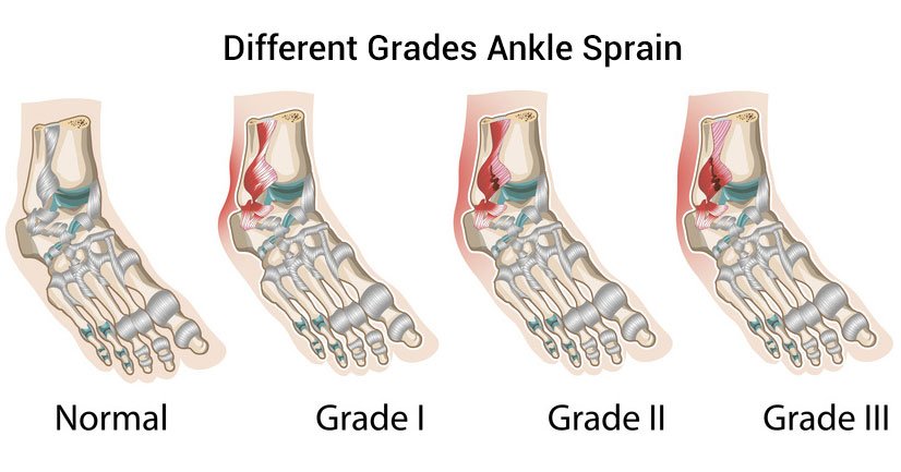 A twisted ankle is the most common sports-related injury