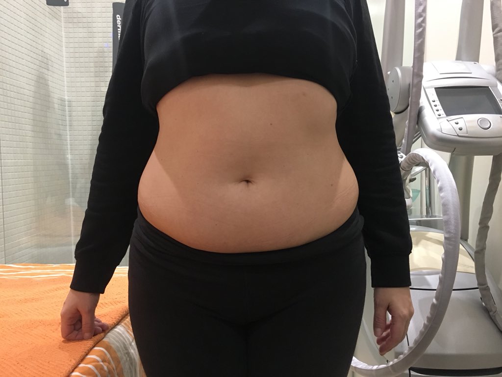 SimplyFatFreeze's tweet photo. Had enough of that extra weight you are carrying, freeze it away with the latest #FatFreezing #FatLoss treatments &amp; get the body you want. https://t.co/6ZZUUudtuH https://t.co/ehJzOmNwzE