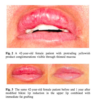 oceancli's tweet image. Ocean Clinic Marbella presents 8-year research into the removal of Aquamid lip filler and techniques for successful lip reconstruction: ow.ly/KSIH30j5Vqz