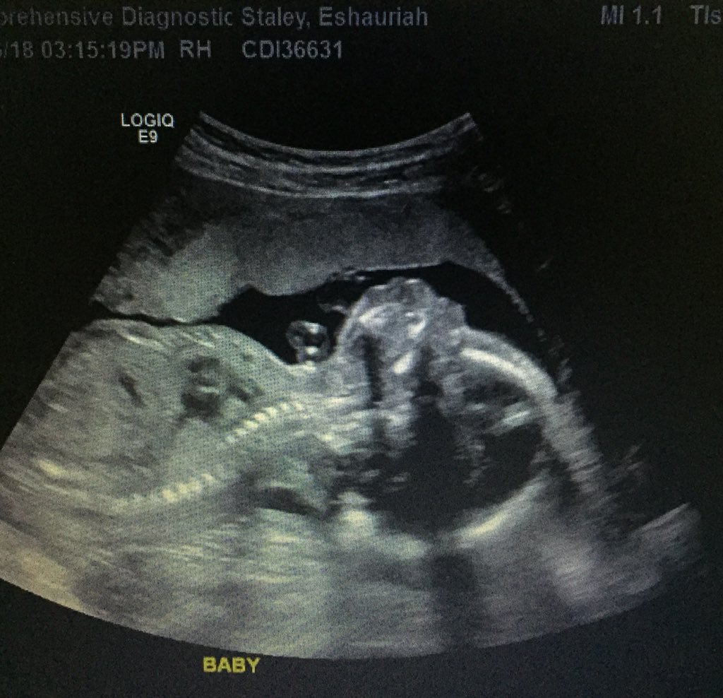 keepinupwithEx3's tweet photo. My sweet baby boy at our anatomy scan a few weeks ago 👣🤗👶🏽 https://t.co/1fye6S1r95